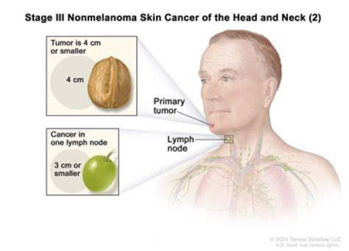 What does a cancerous lymph node feel like?