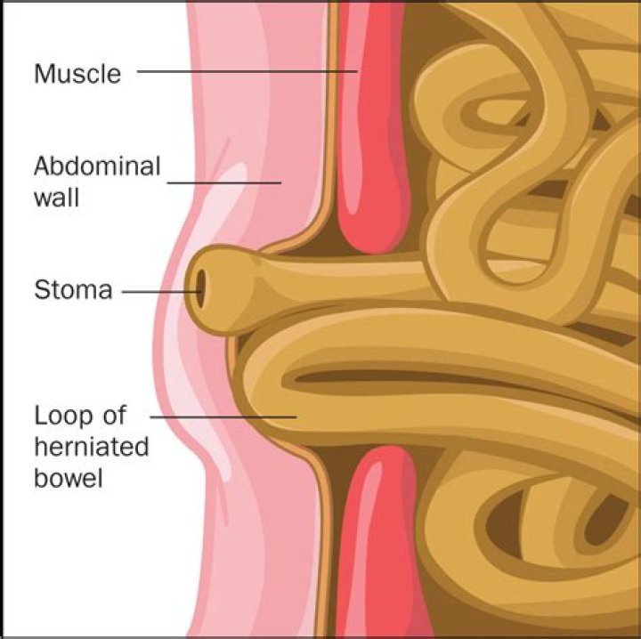 What does a herniated stoma look like?
