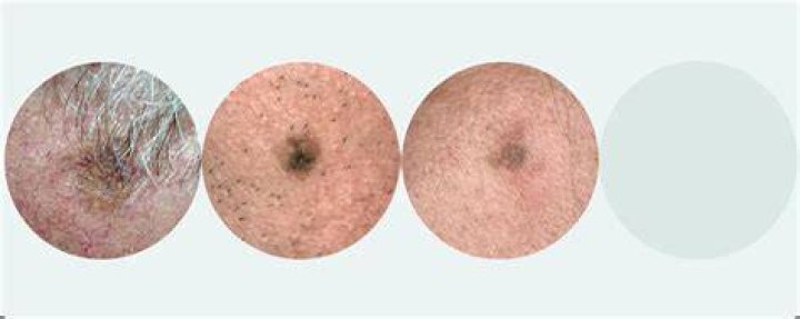 What does a melanoma look like when it first appears?