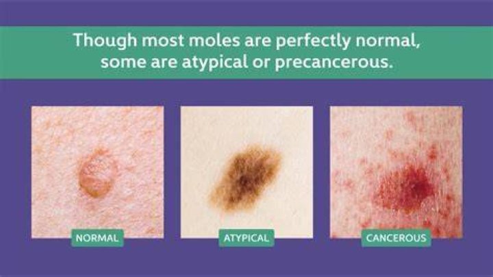 What does a mole on breast mean?