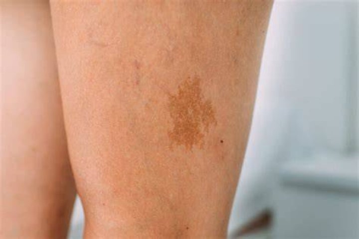 What does birthmark on left leg mean?