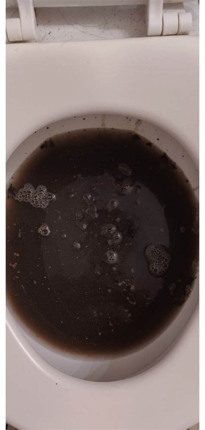 What does black liquid diarrhea mean?