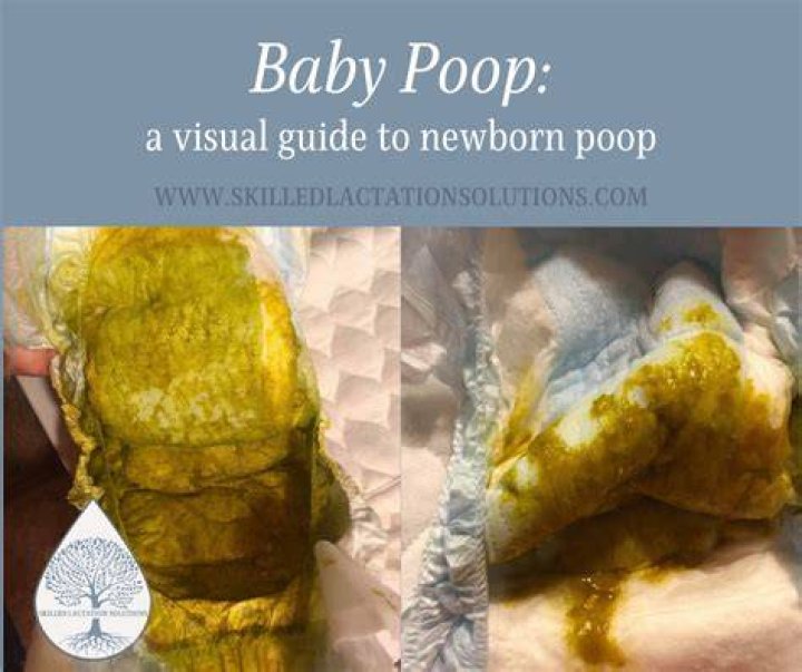 What does CF baby poop look like?