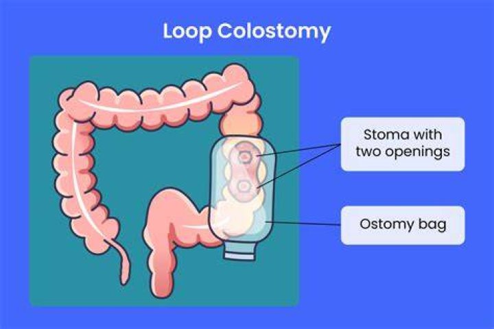 What does colostomy poop look like?