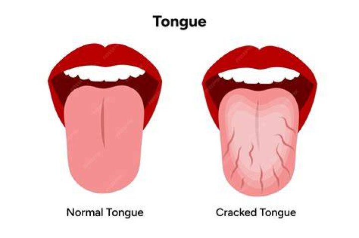 What does cracks in tongue mean?