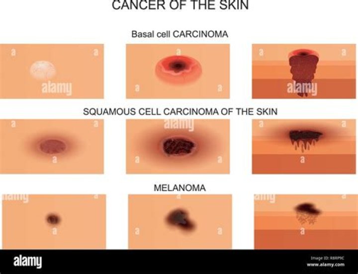 What does early skin necrosis look like?