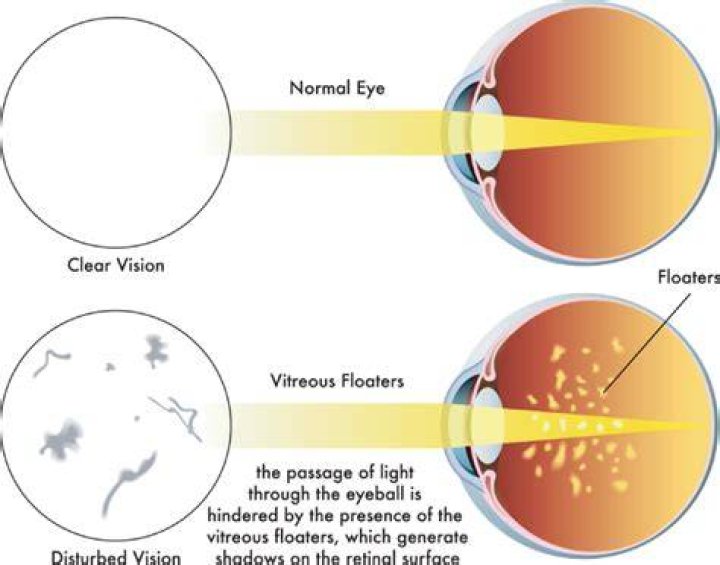 What does floating black dots mean?