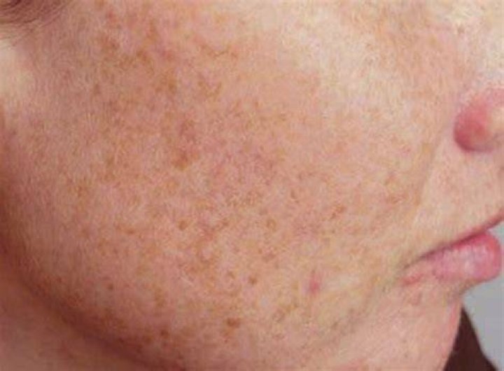 What does liver spots look like?