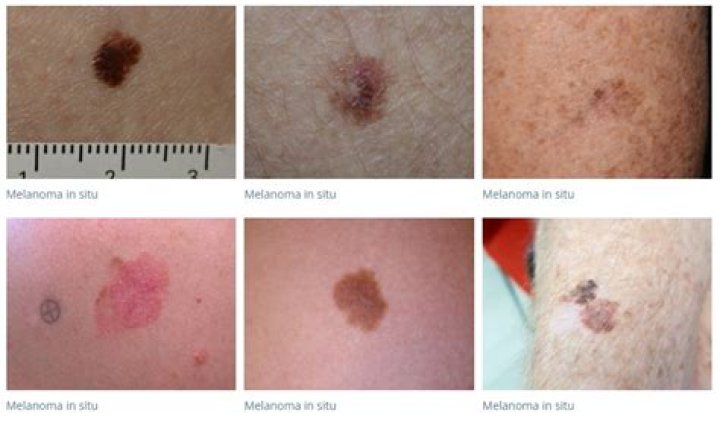 What does melanoma in situ look like?