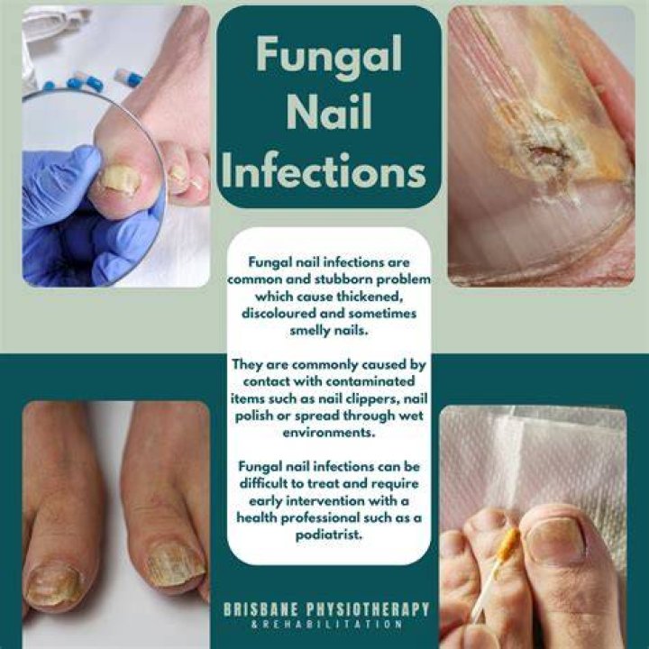 What does nail fungus feed on?