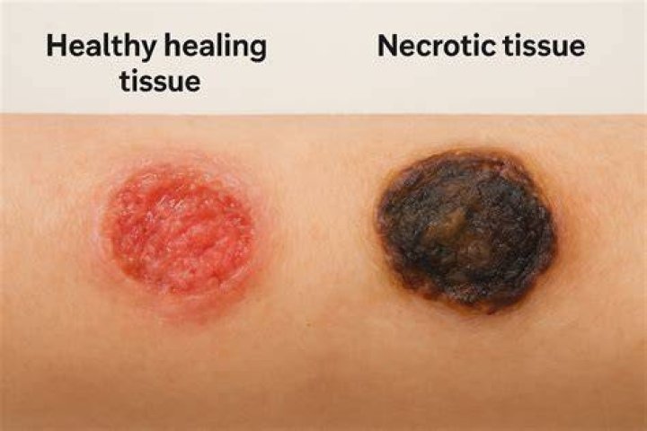What does necrotic skin look like?