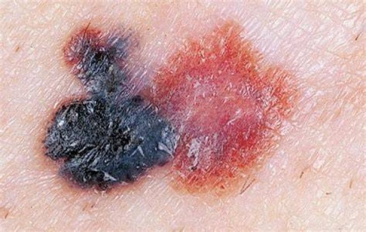 What does nodular melanoma look like?