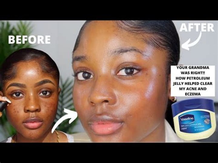What does petroleum jelly do to your face?