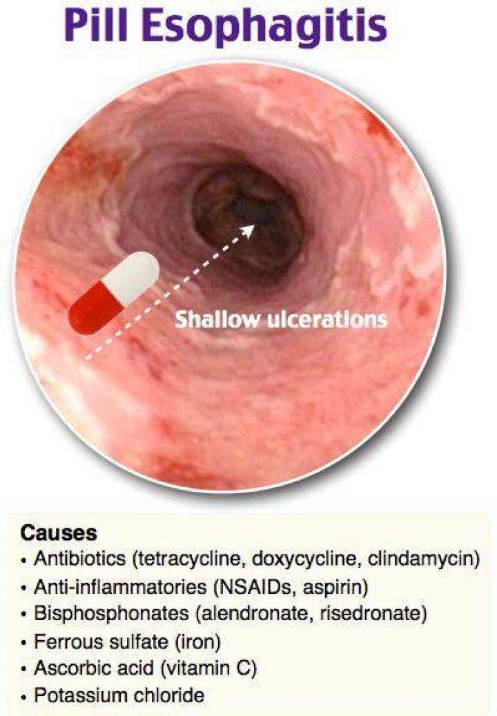 What does pill esophagitis feel like?