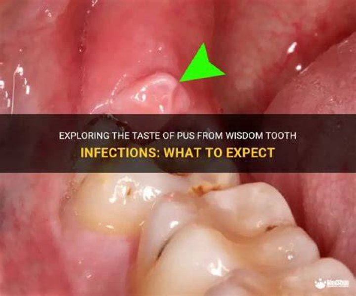 What does pus in your mouth taste like?