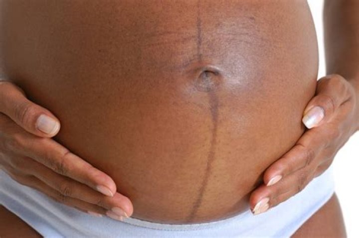 What does the black line on a pregnant belly mean?