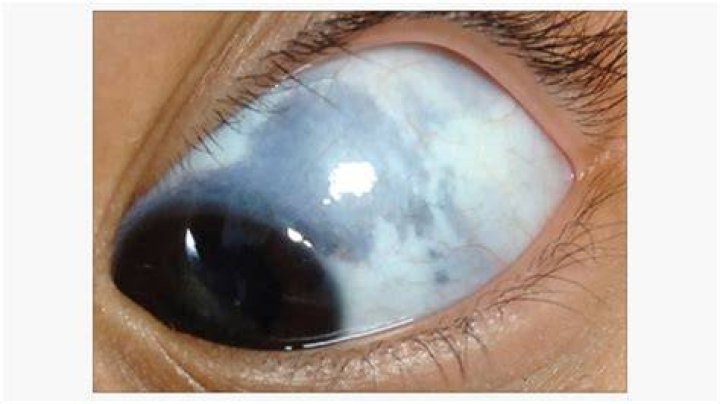 What does white eye Stone do?