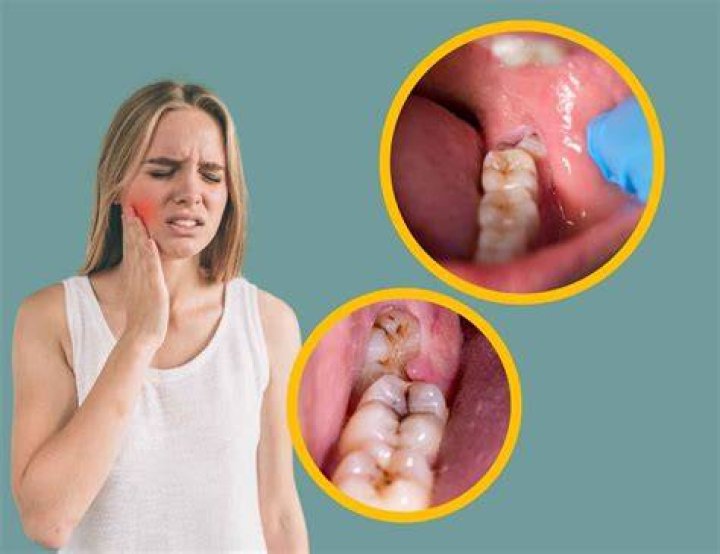 What does wisdom teeth pain feel like?