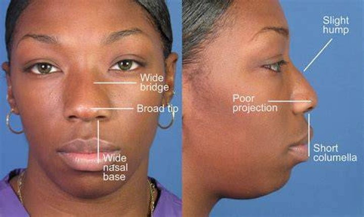 What ethnicities have low nose bridge?