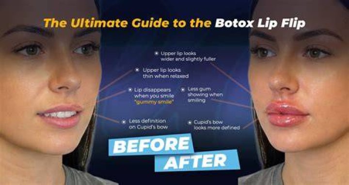 What happens after lip flipping Botox?