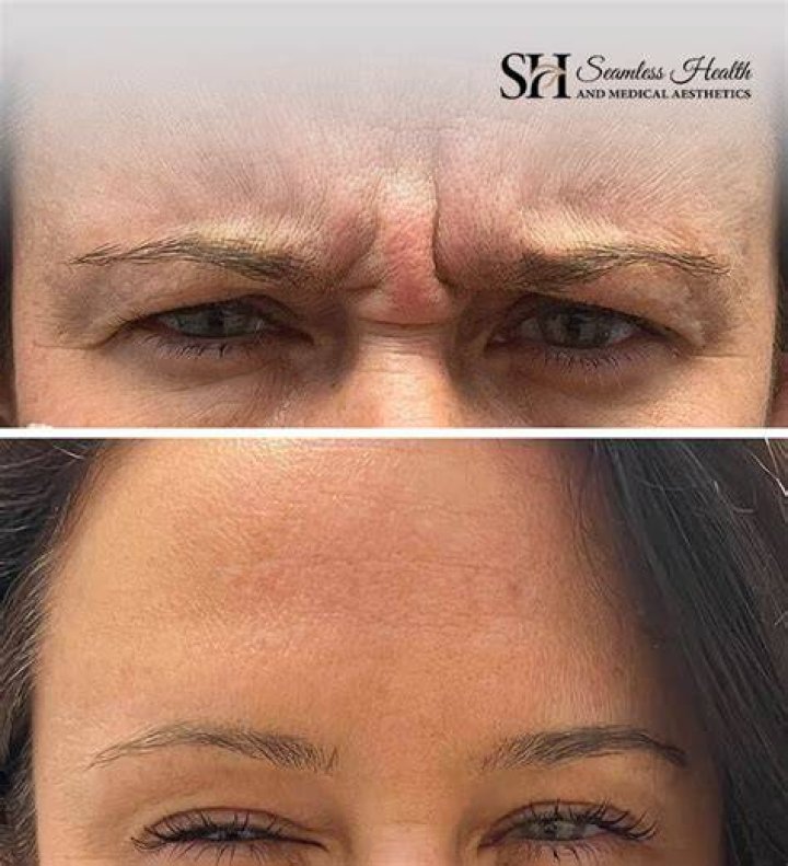 What happens after you stop Botox?