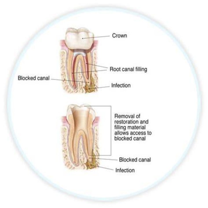 What happens during a root canal retreatment?