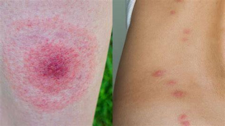 What happens if a bird bites you?