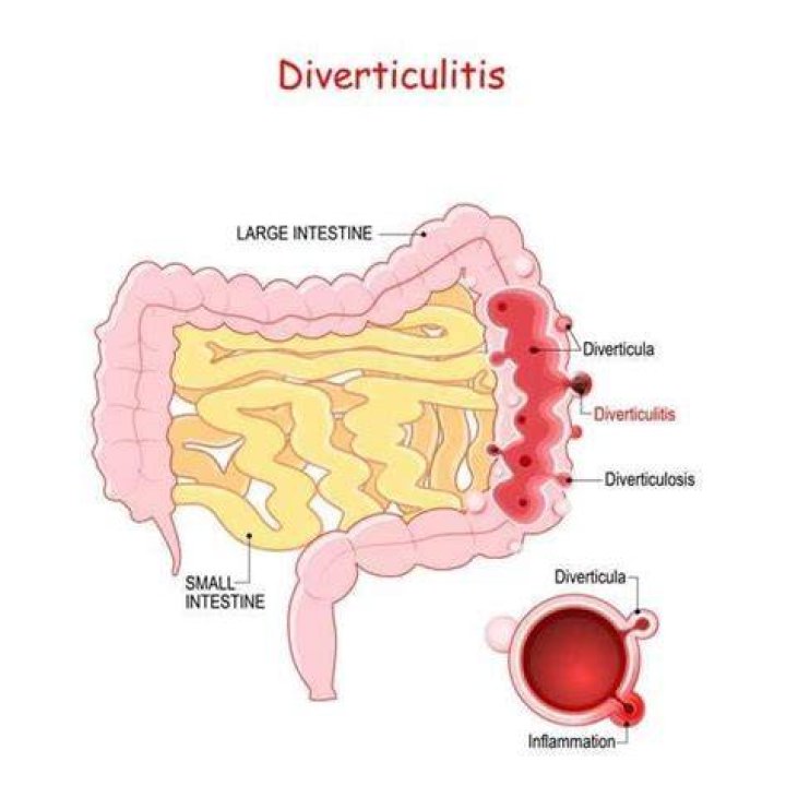 What happens if diverticulitis goes untreated?