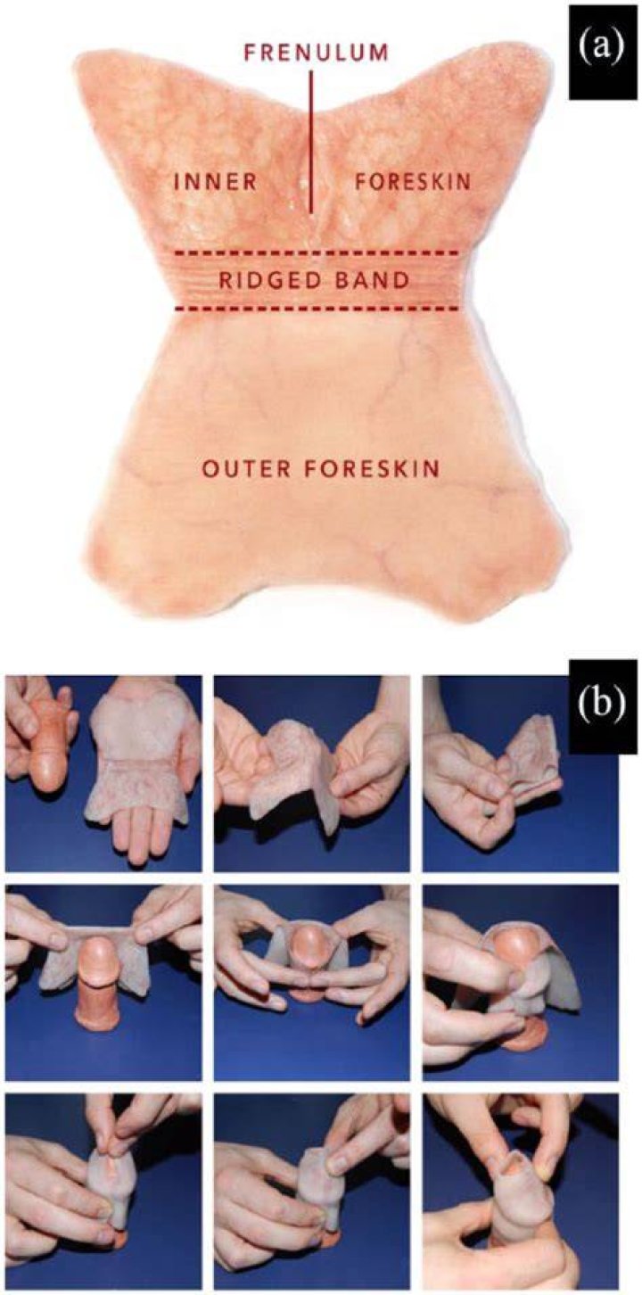 What happens if not enough foreskin is removed?