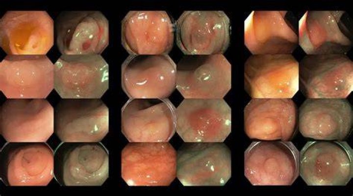What happens if they find a tumor during a colonoscopy?
