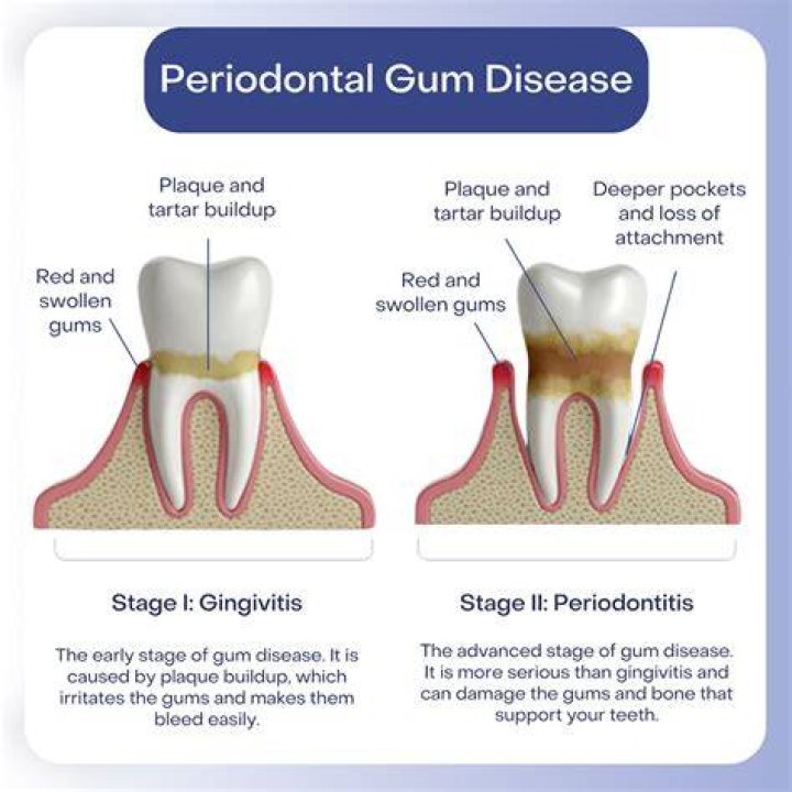 What happens if you don't treat periodontal disease?