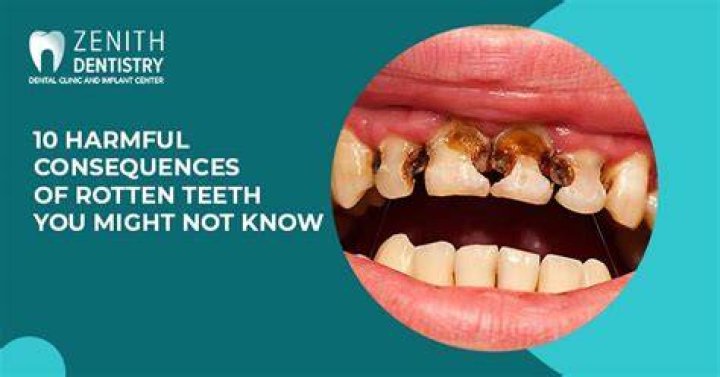 What happens if you leave a rotten tooth in your mouth?
