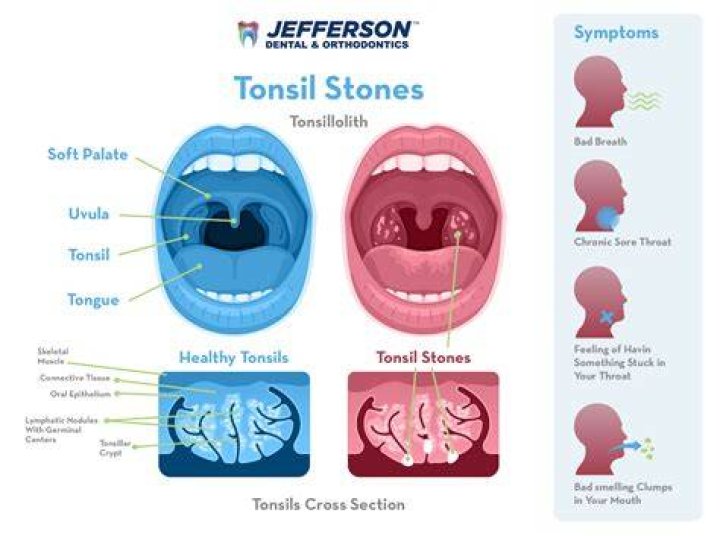 What happens if you swallow tonsil stones?