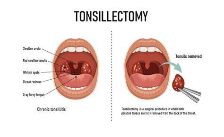 What happens if you vomit after tonsillectomy?