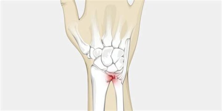 What happens if your wrist heals improperly?