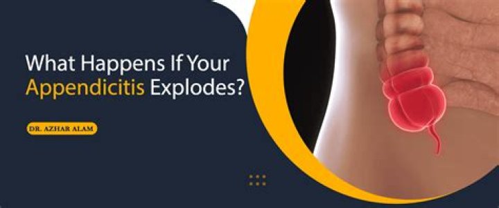 What happens when appendix bursts?