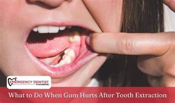 What helps gum pain after tooth extraction?