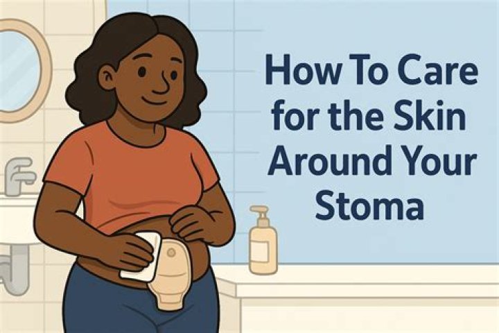 What helps skin breakdown around stoma?