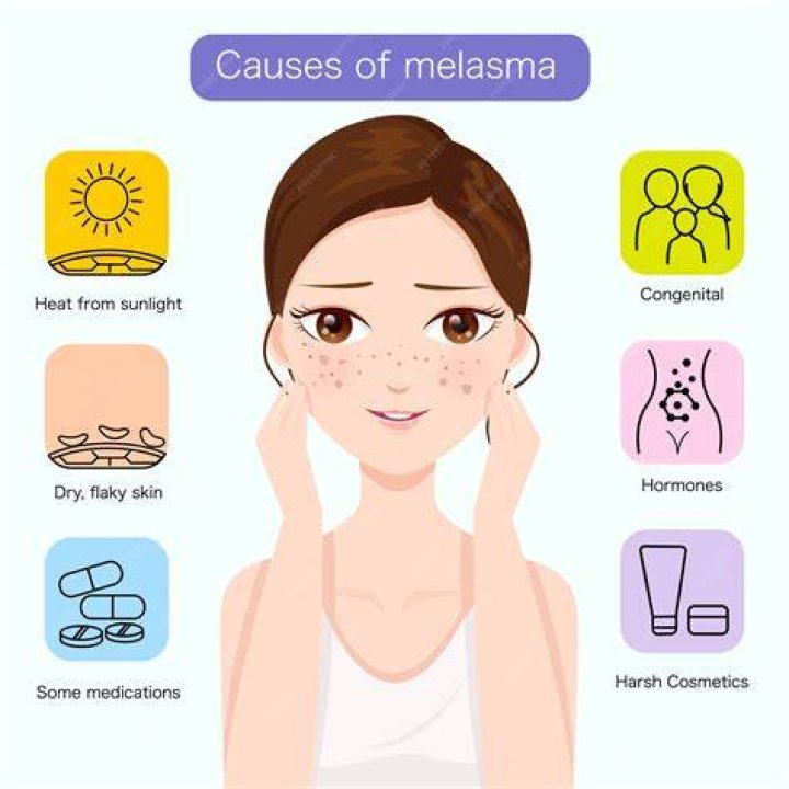 What hormone causes melasma?