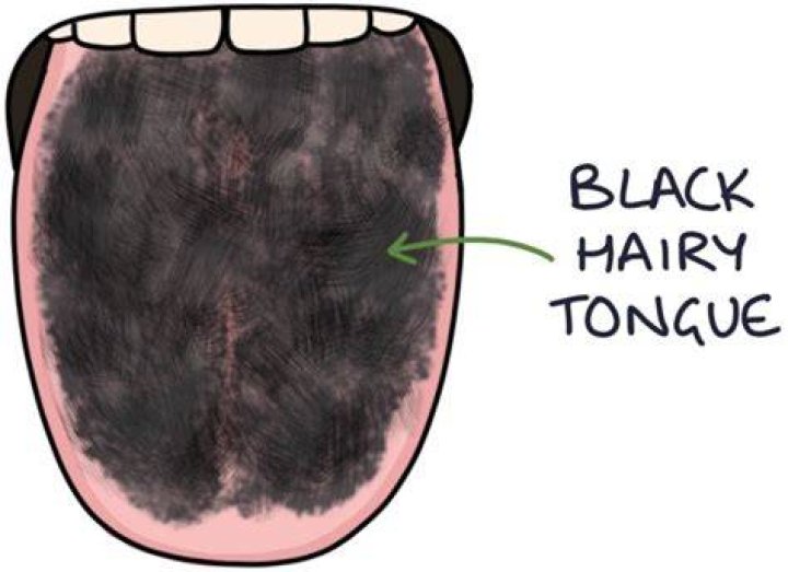 What is a black hairy tongue called?