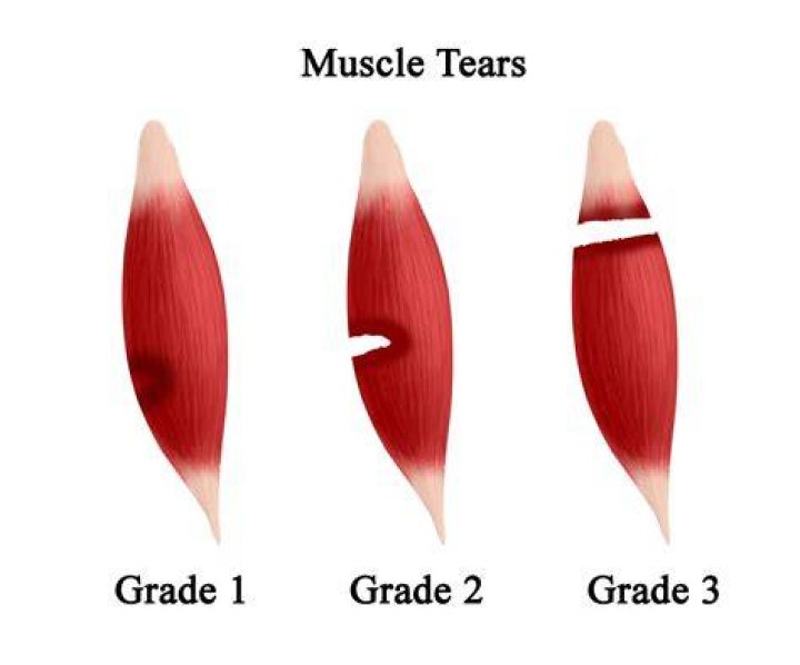 What is a Grade 4 muscle tear?