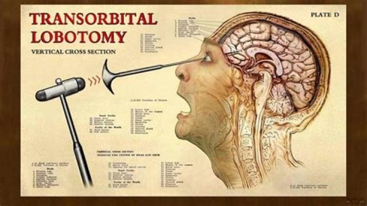 What is a lobotomy supposed to do?