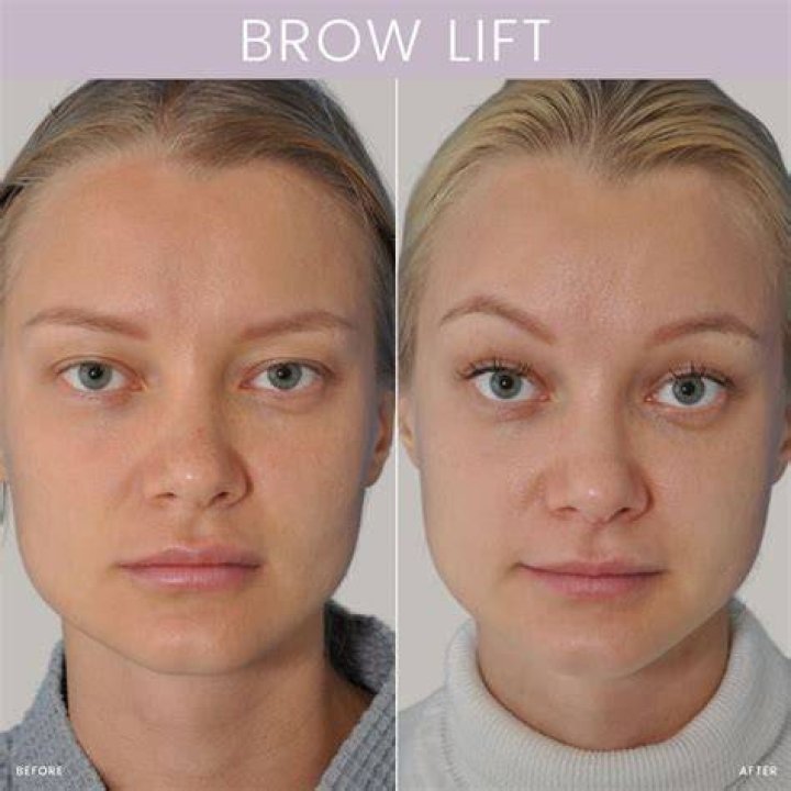 What is a mini brow lift?