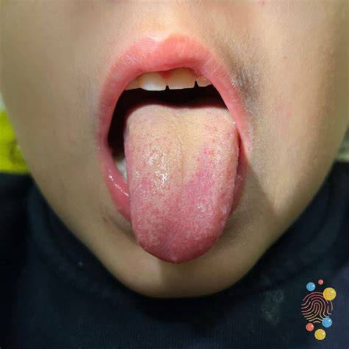 What is a raspberry tongue?