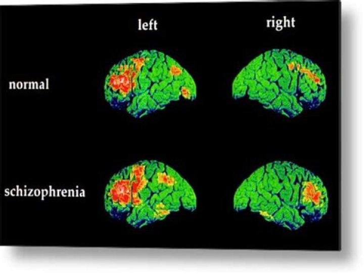 What is a schizophrenic break?