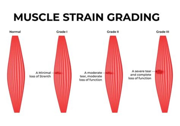What is a strong indicator of a Grade III muscle strain?