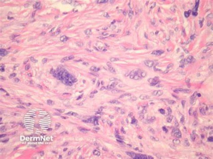 What is an atypical dermatofibroma?