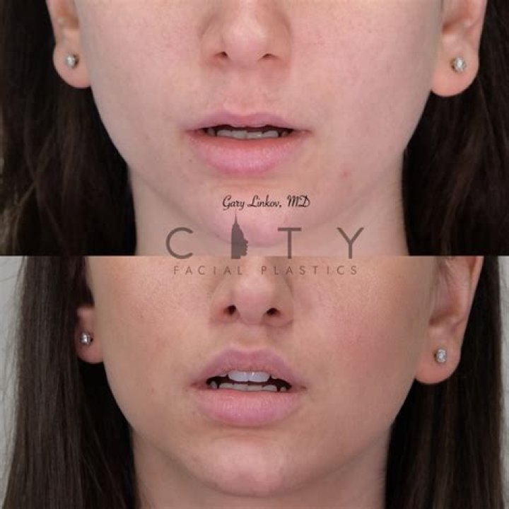 What is an Elelyft lip lift?