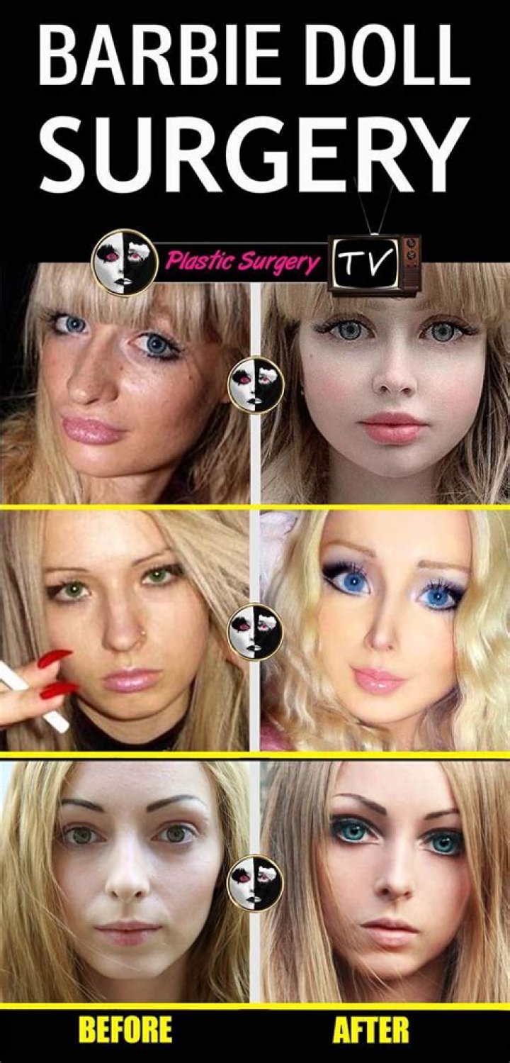 What is Barbie surgery?