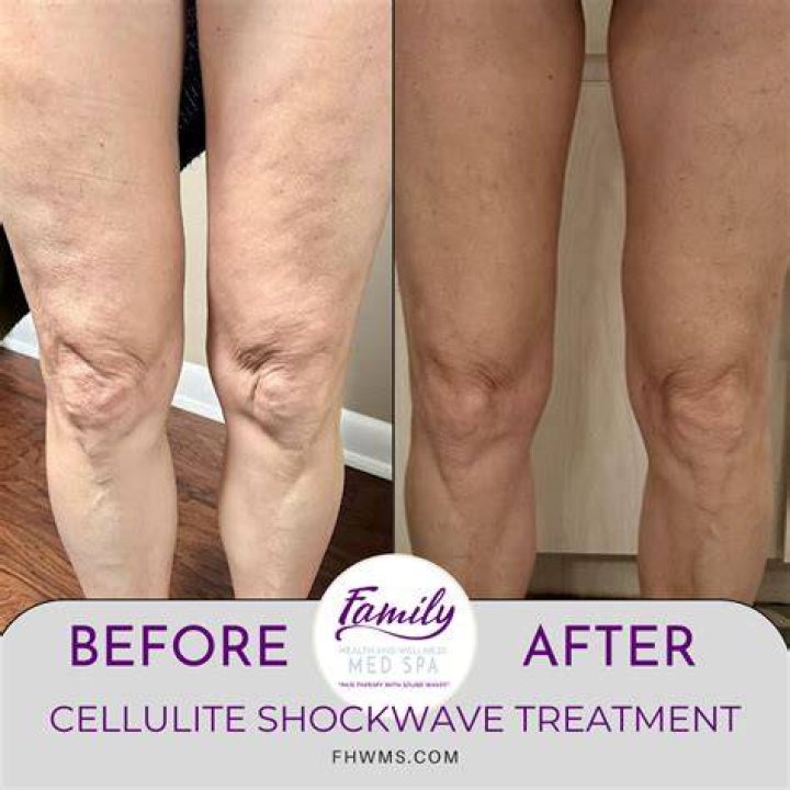 What is best cellulite treatment?